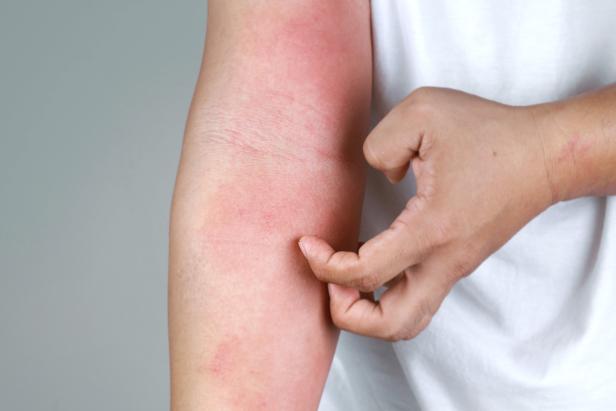 Atopische Dermatitis
