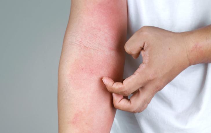 Faktoren, die die Behandlung von AD beeinflussen können