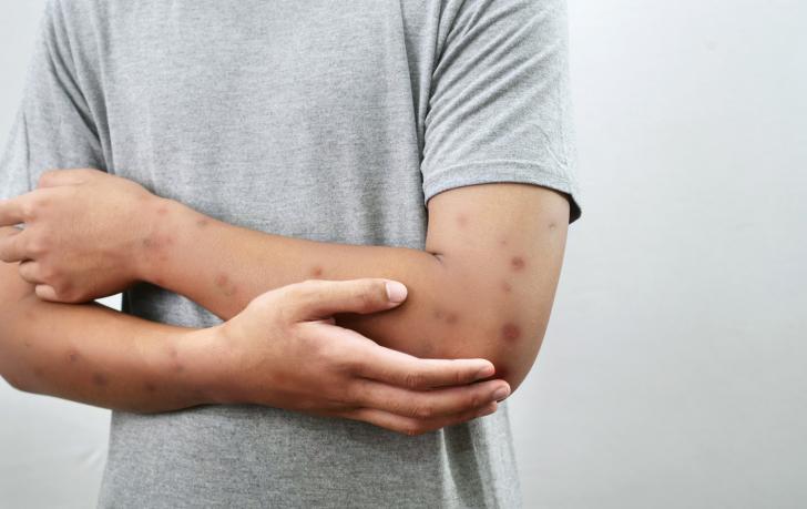 Was ist Prurigo nodularis?