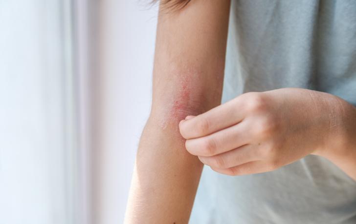 Was ist atopische Dermatitis?