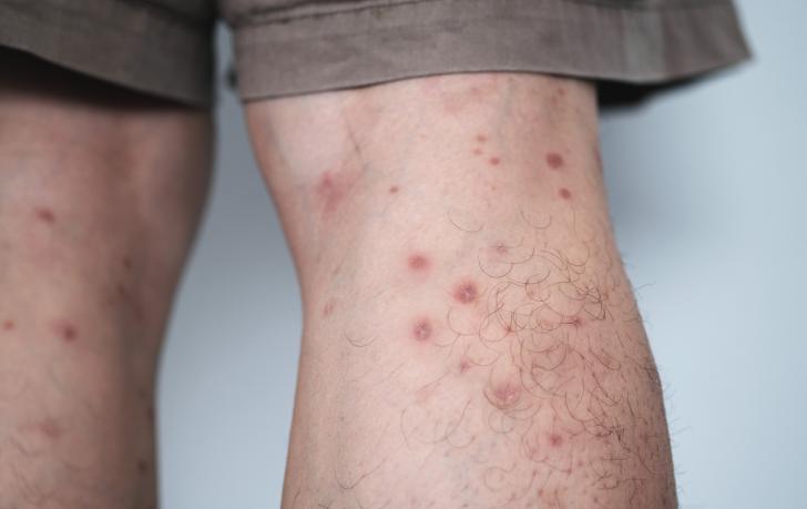 Faktoren, die die Behandlung von PN beeinflussen können