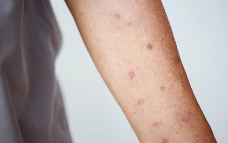 Was ist Prurigo nodularis?