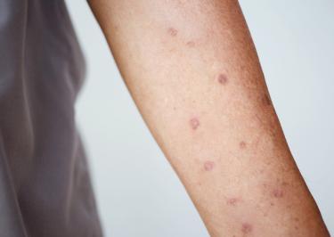 Therapiebeginn mit NEMLUVIO®